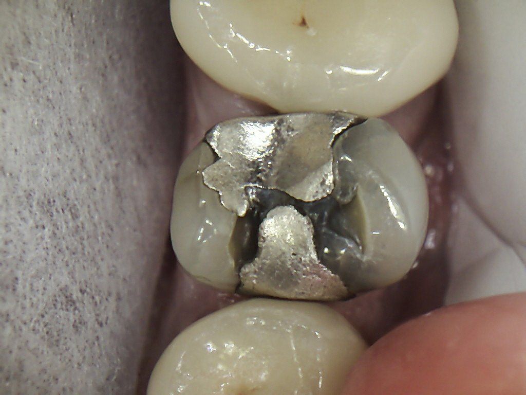 A close up of a tooth with a broken metal filling in it.