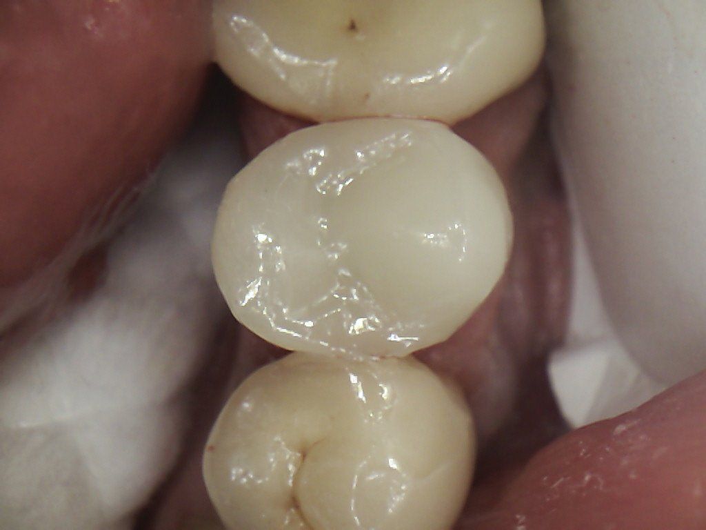 A close up of three teeth in a person 's mouth.