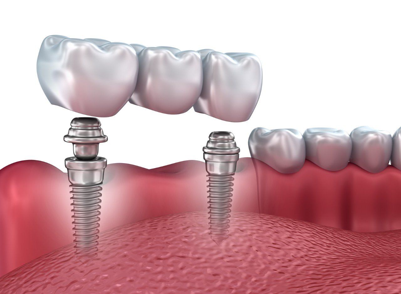 A computer generated image of a dental bridge being installed in a mouth.