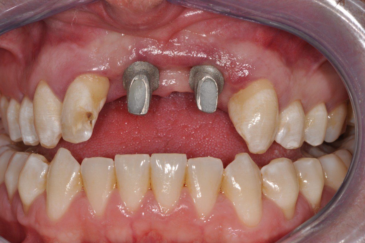 A close up of a person 's teeth with two dental implants in them.