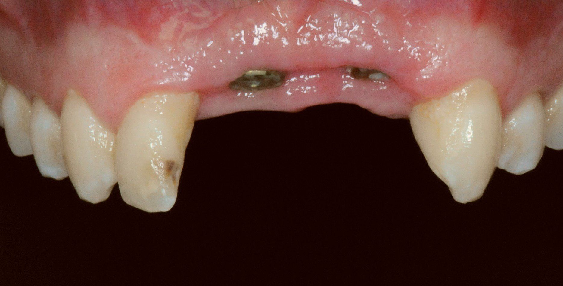 A close up of a person 's mouth with missing teeth.