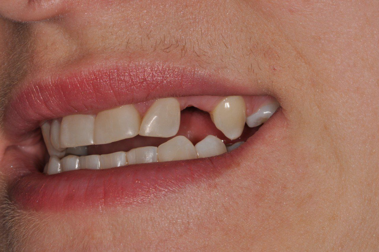 A close up of a person 's mouth with a missing tooth.
