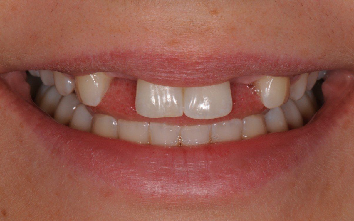 A close up of a person 's mouth with missing teeth.