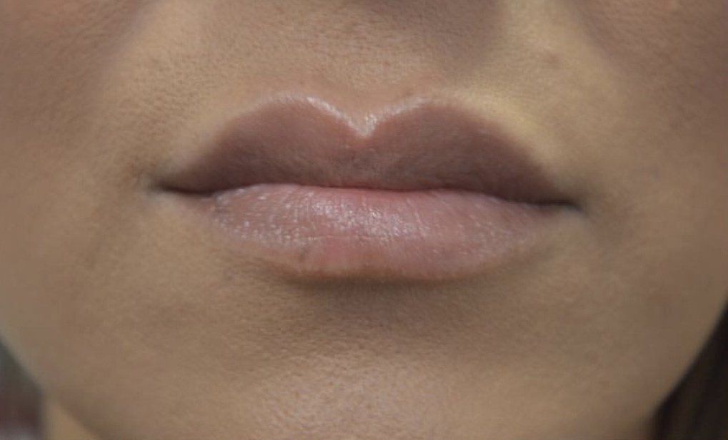 Juvéderm Voluma injection - Aesthetic & Wellness in Placentia, CA