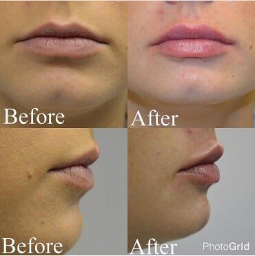 Juvéderm Voluma injection - Aesthetic & Wellness in Placentia, CA