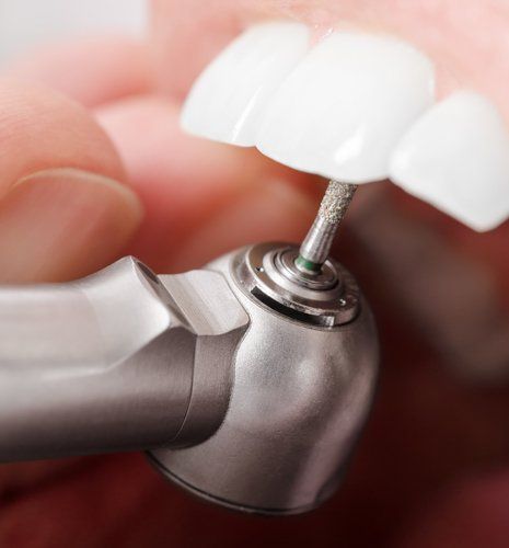 Dental Fillings — Closeup of Teeth Being Drilled by Dentist in Brownsburg, IN Dental Fillings — Closeup of Teeth Being Drilled by Dentist in Brownsburg, IN