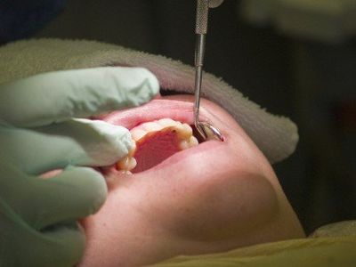 Dental bridges