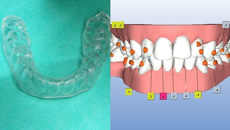 posizione denti
