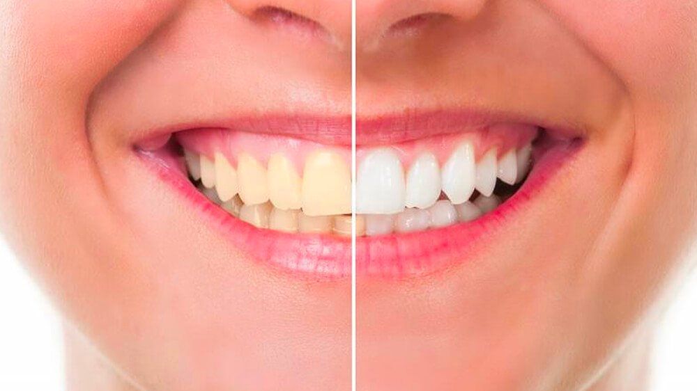 Cosmetic Dental Services — Pittsburgh, PA — Pittsburgh Dental Spa Cosmetic Dental Services — Pittsburgh, PA — Pittsburgh Dental Spa