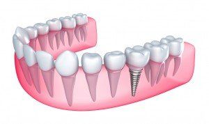 Dental Implants — Pittsburgh, PA — Pittsburgh Dental Spa Dental Implants — Pittsburgh, PA — Pittsburgh Dental Spa