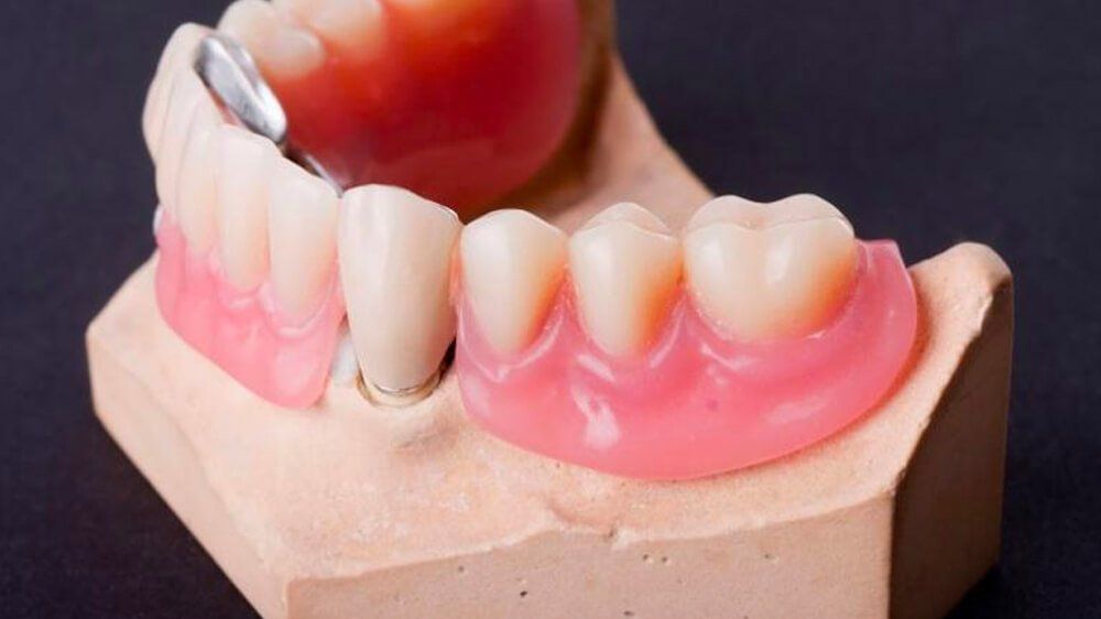 Missing Teeth Demo — Pittsburgh, PA — Pittsburgh Dental Spa Missing Teeth Demo — Pittsburgh, PA — Pittsburgh Dental Spa