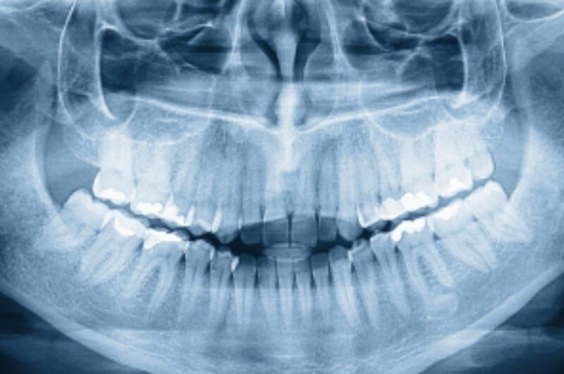 X-Ray — Pittsburgh, PA — Pittsburgh Dental Spa X-Ray — Pittsburgh, PA — Pittsburgh Dental Spa
