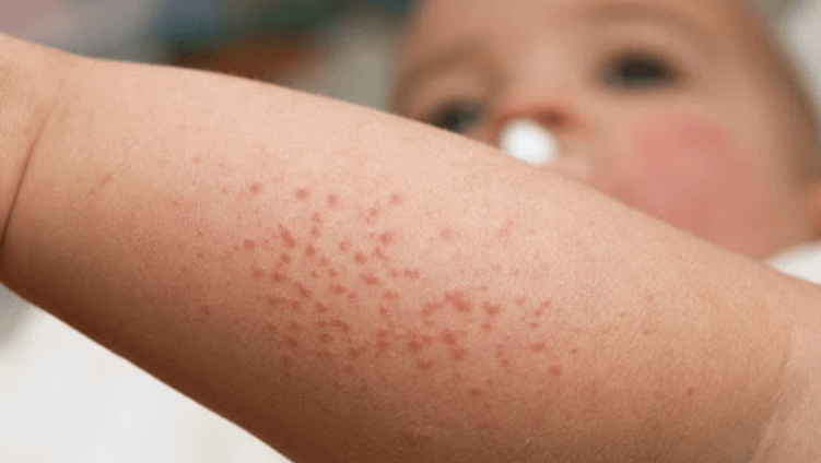 a close up of a baby 's arm with red spots .