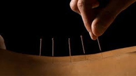 Sessione di agopuntura