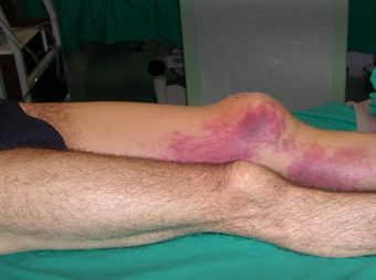 artrosi cervicale