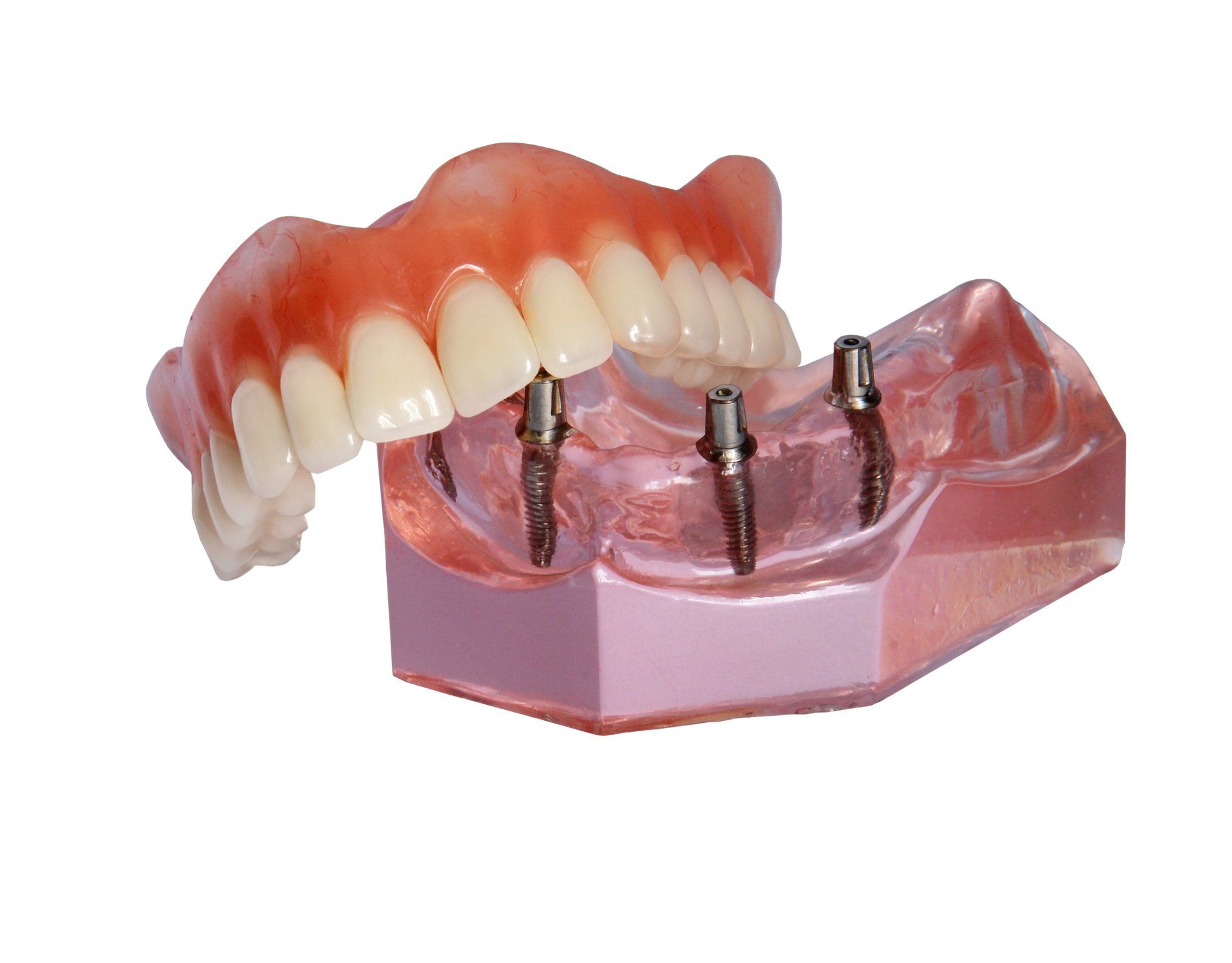 Een set boventanden van een prothese, zwevend boven een transparant model van een kaak met drie metalen implantaatsteunpunten.