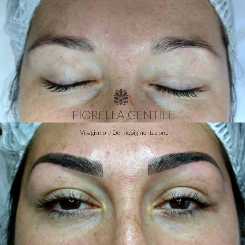 correggere alopecia