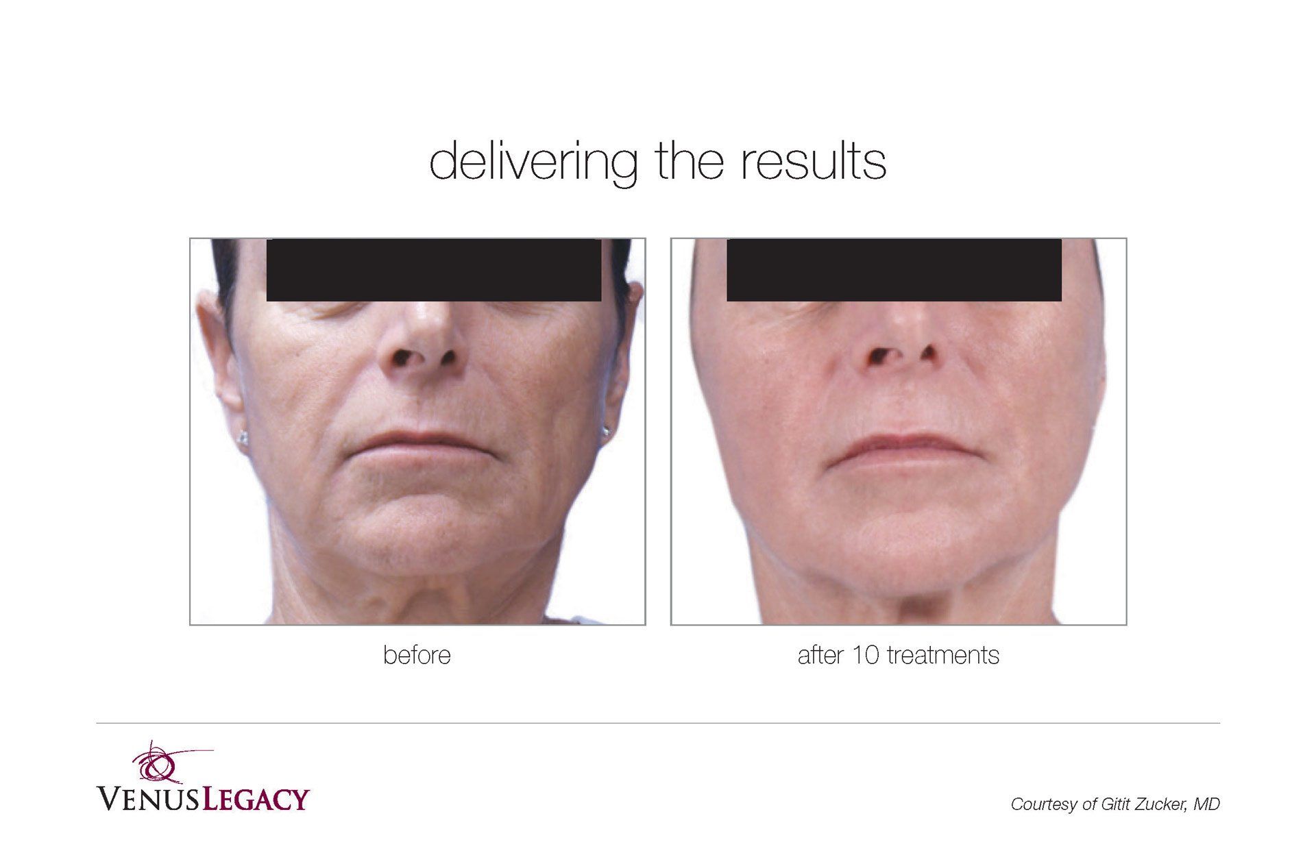 Face Lift Before And After Treatment — Beach, FL — Skinny Jax