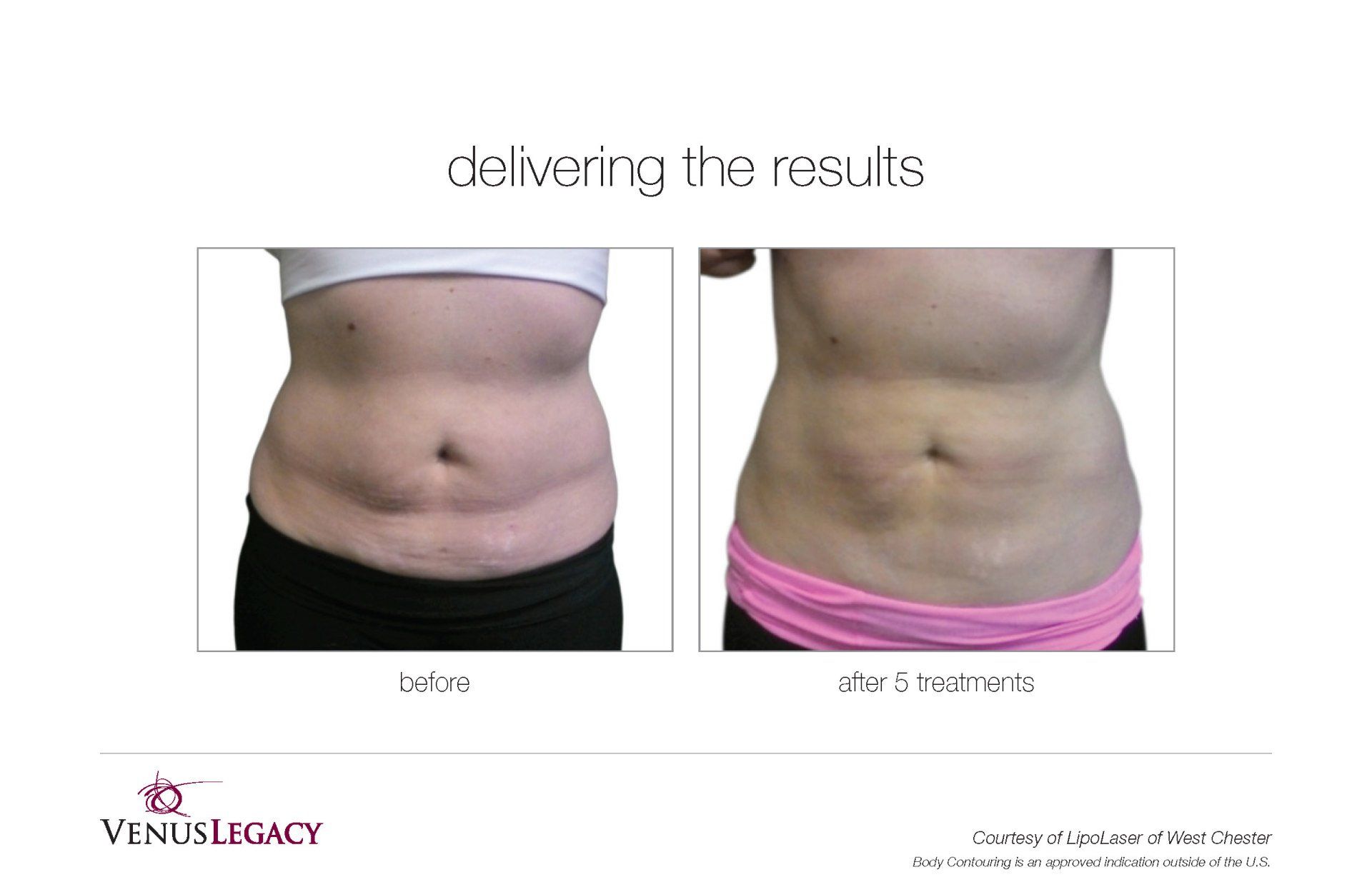 Woman Flat Stomach Before And  After 8 Treatment — Beach, FL — Skinny Jax