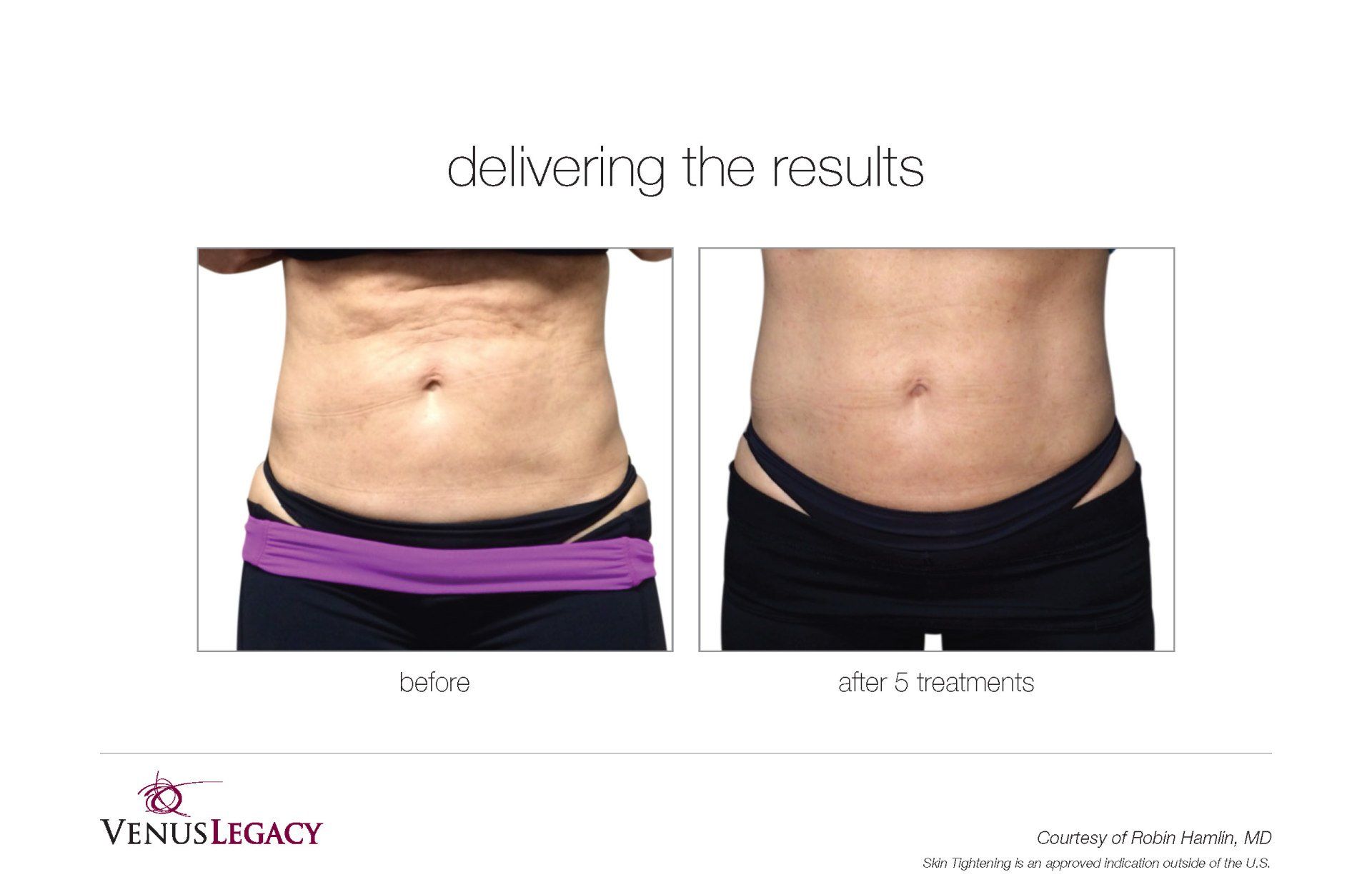 Front View Stomach Before And After Treatment — Beach, FL — Skinny Jax
