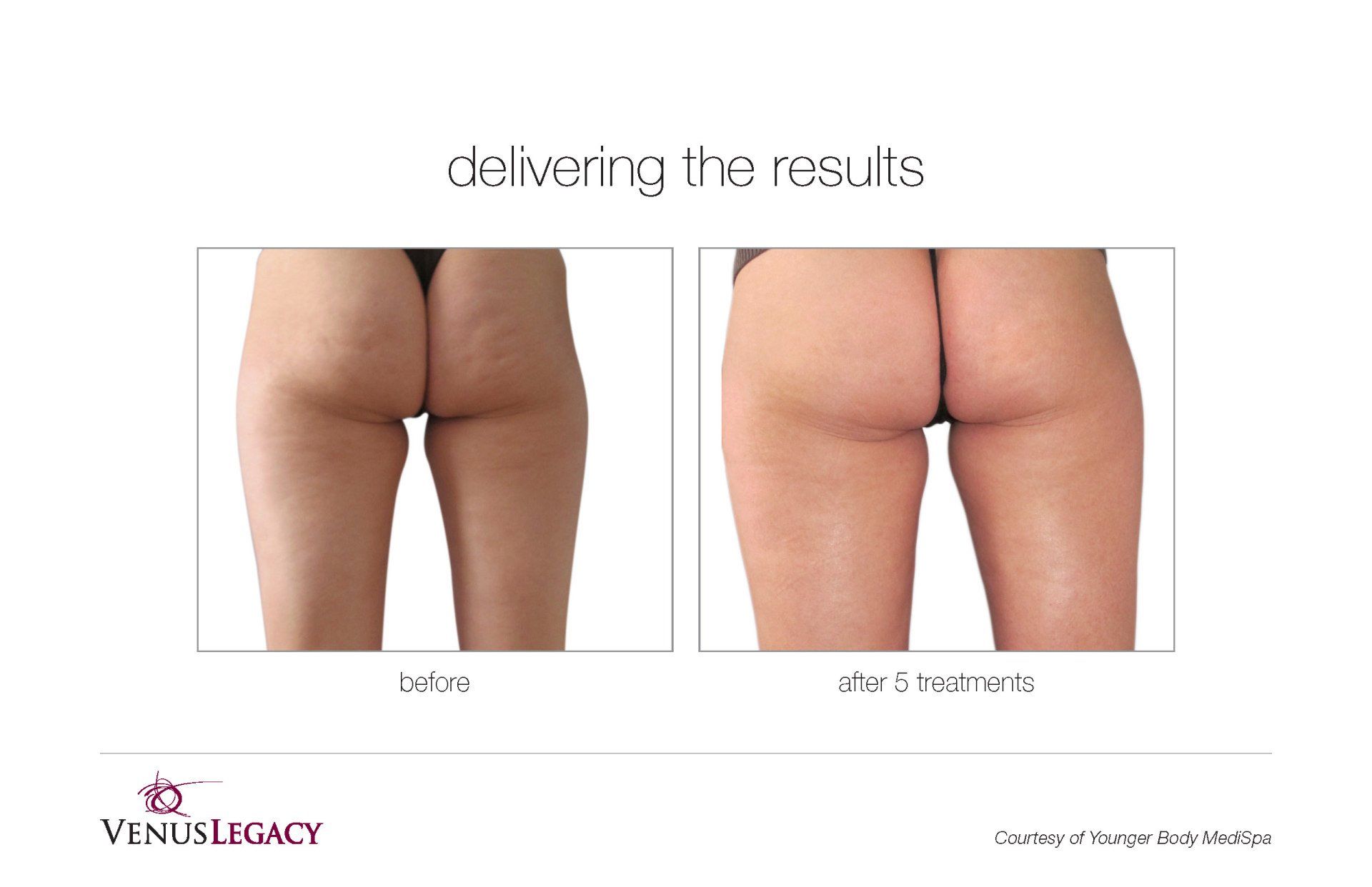 Woman Back View Before And After Treatment — Beach, FL — Skinny Jax