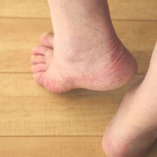 Heel - Foot Doctor in Swampscott, MA
