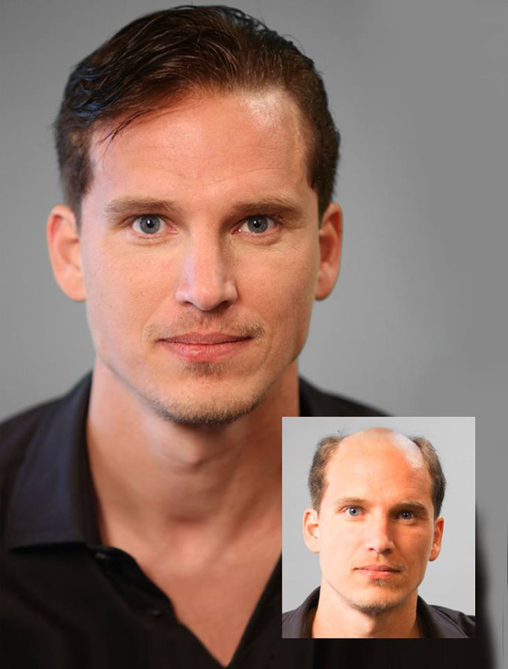 before and after view of man hair restoration