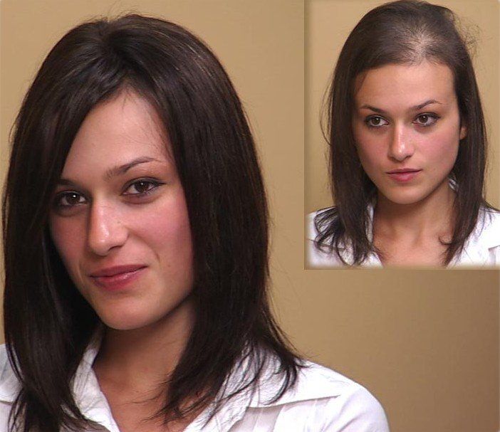 female hair restoration