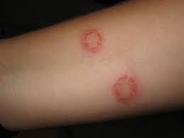 ringworm infection