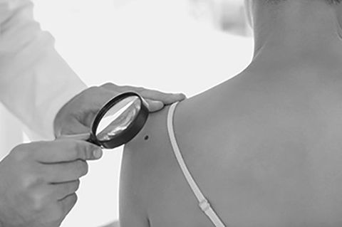 Skin Cancer Surgery | Biopsy or Removal Johannesburg | Dr. Anton Brewis