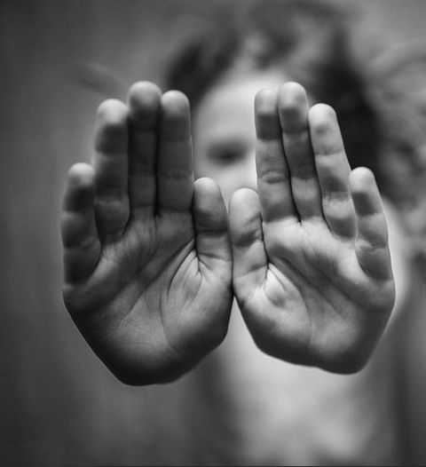 Hands or Syndactyly Johannesburg | Dr. Anton Brewis