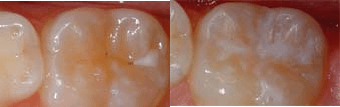 Tooth Development Tooth Development
