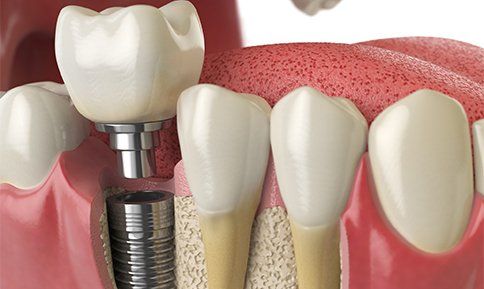 Teeth Dental Implant — Washington, PA — Snee Dental Associates Teeth Dental Implant — Washington, PA — Snee Dental Associates