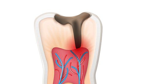 Tooth Decay — Washington, PA — Snee Dental Associates Tooth Decay — Washington, PA — Snee Dental Associates
