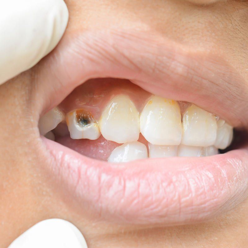 tooth with cavity