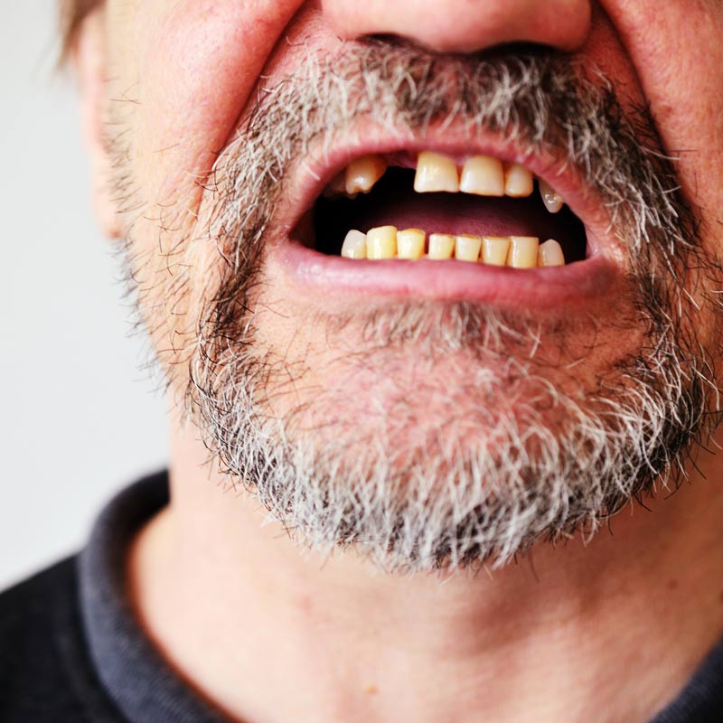 man with knocked out tooth
