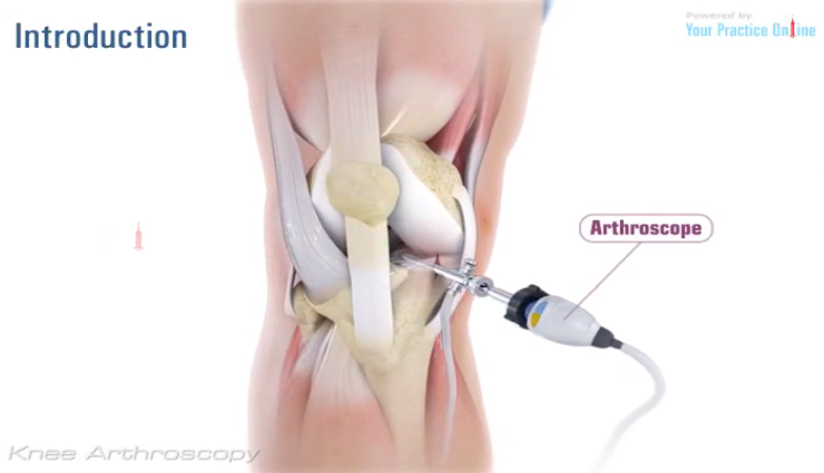 A knee with an arthroscope attached to it