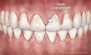 A close up of a person 's teeth with gum overgrowth.