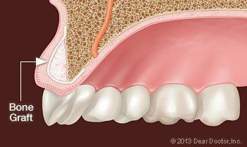 bone graft