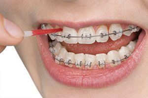 brushing with braces