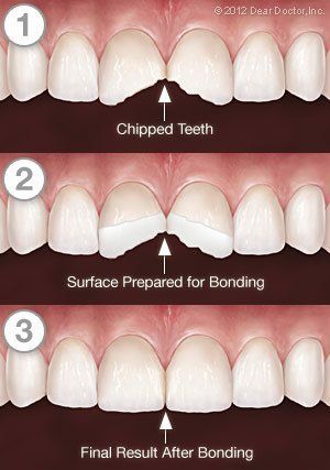 cracked teeth bonding