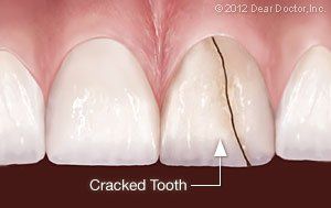 cracked tooth