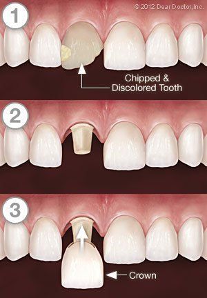 A diagram of a tooth being replaced with a crown