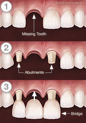 A diagram of a missing tooth , abutments , and a bridge.