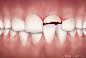 broken tooth