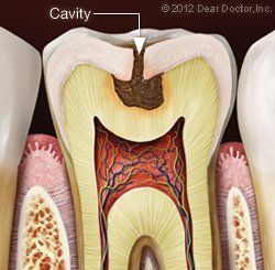 cavity