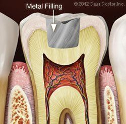 metal filling