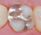 A close up of a tooth with a metal filling in it.