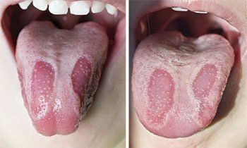 geographic tongue