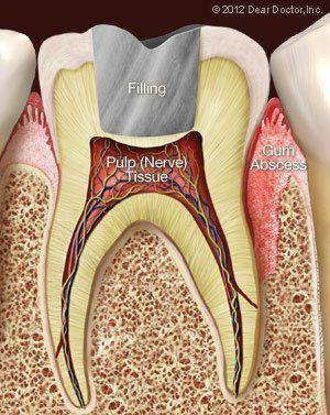 A diagram of a tooth showing the pulp nerve tissue and gum abscess